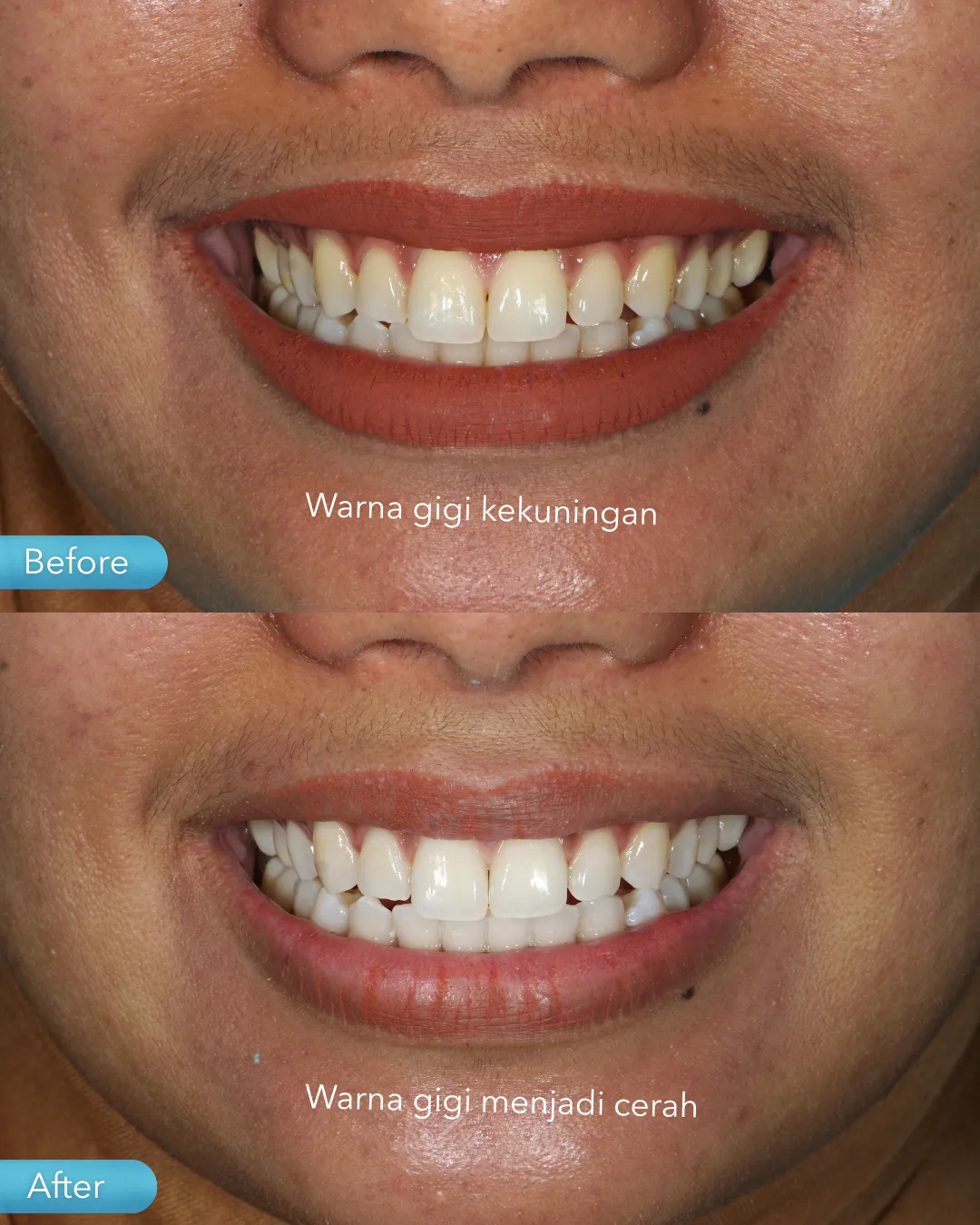 Teeth whitening result